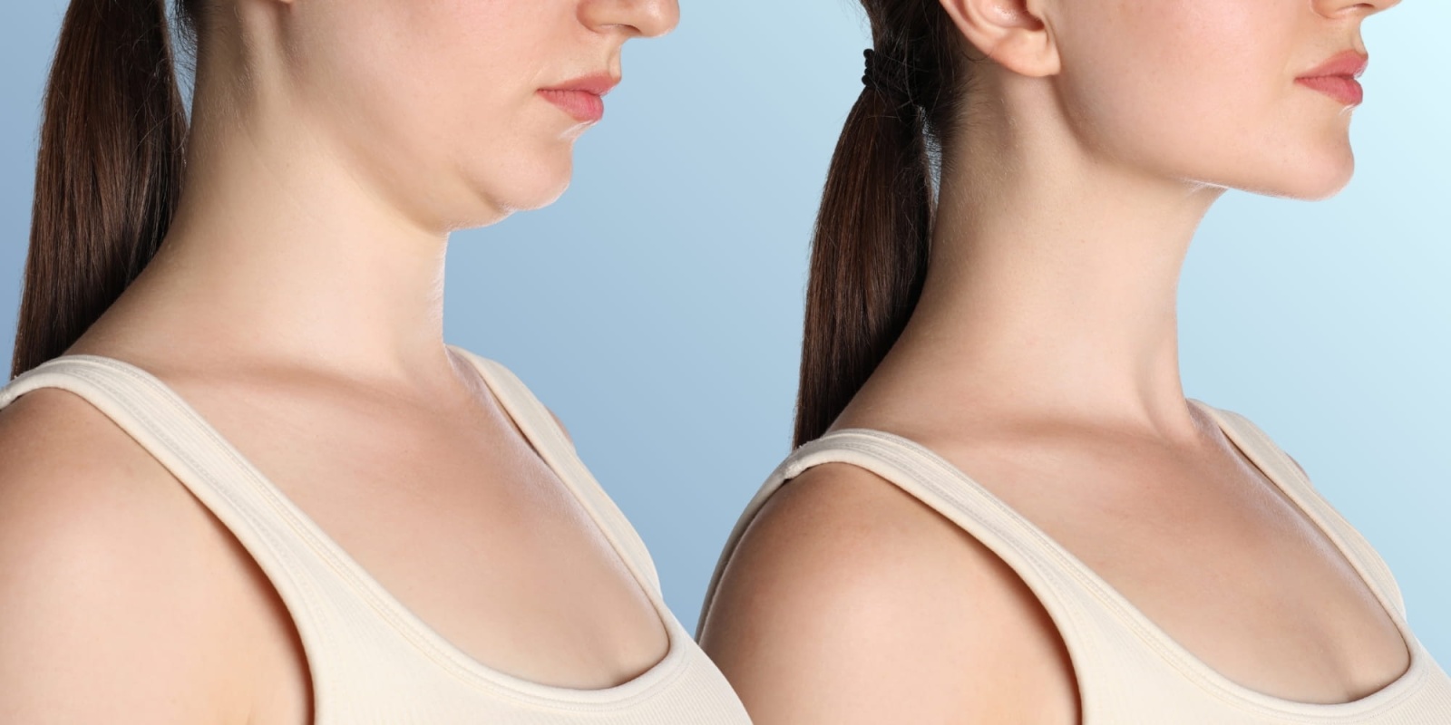 Виды и степени выраженности второго подбородка