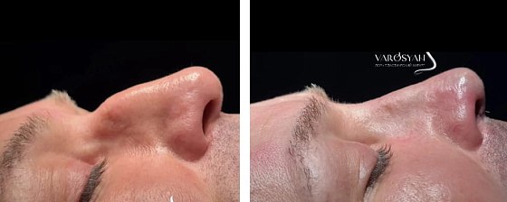 Ринопластика: до и после – фото 24