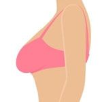 После родов грудь потеряла прежнюю форму и нужно восполнить ее объем или подтянуть