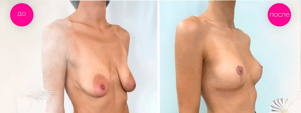 фото до и после