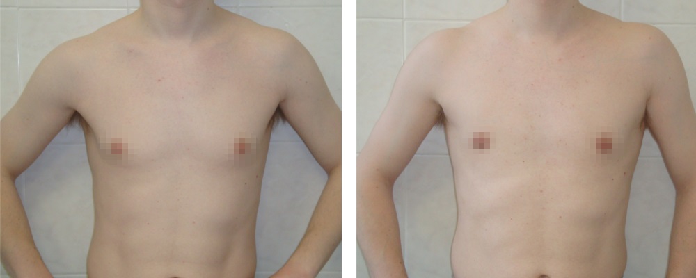 Гинекомастия: до и после – фото 12