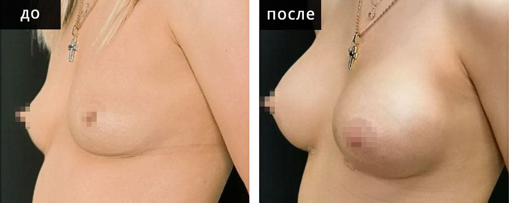 Маммопластика - увеличение груди. Глебова 03: до и после – фото 10