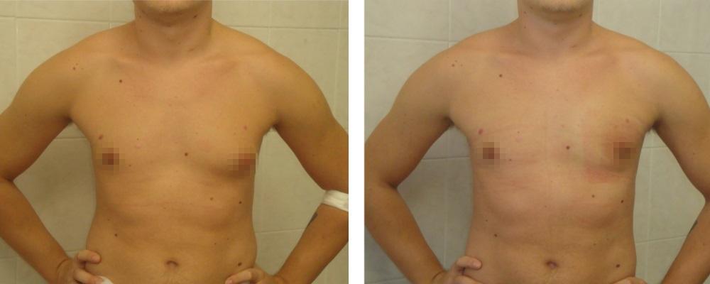 Гинекомастия: до и после – фото 18