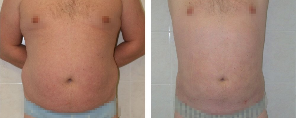 Липосакция для мужчин: до и после – фото 2