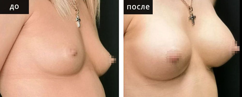 Маммопластика - увеличение груди. Глебова 02: до и после – фото 9