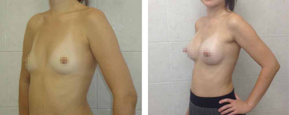 Маммопластика. Еременко В.С._21: до и после – фото 50