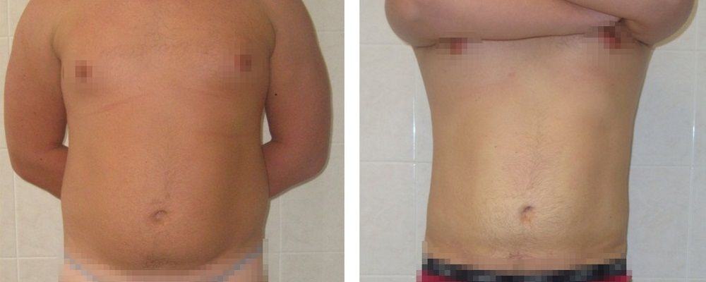 Липосакция для мужчин: до и после – фото 7