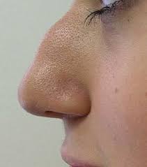 Ринопластика при коррекции горбинки на носу