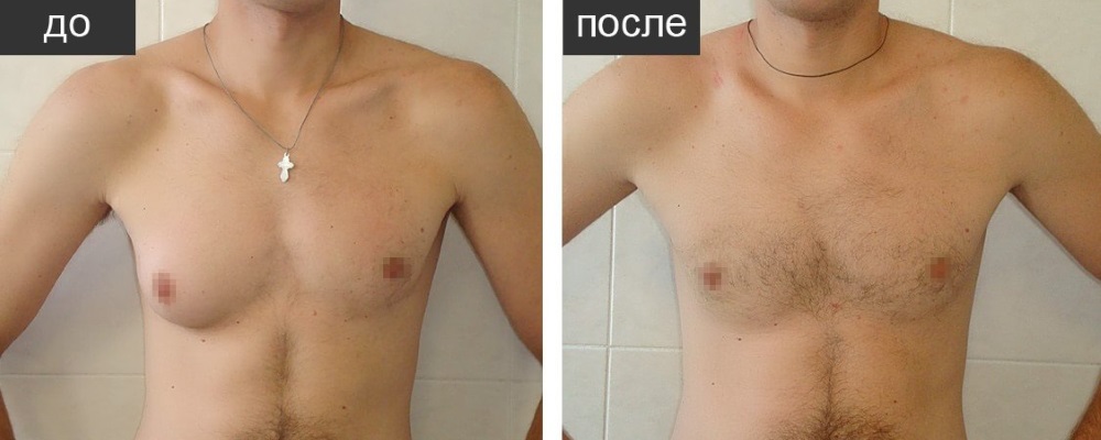 Гинекомастия: до и после – фото 5