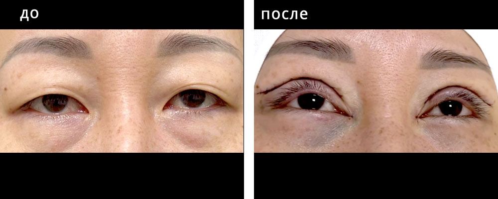 Блефаропластика азиатских глаз. Болотбекова 05: до и после – фото 4