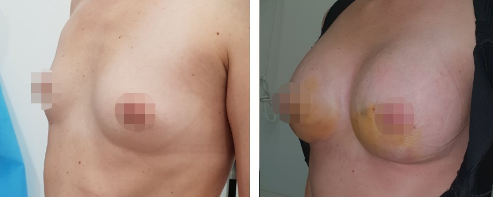 Горячих Мамопластика: до и после – фото 2