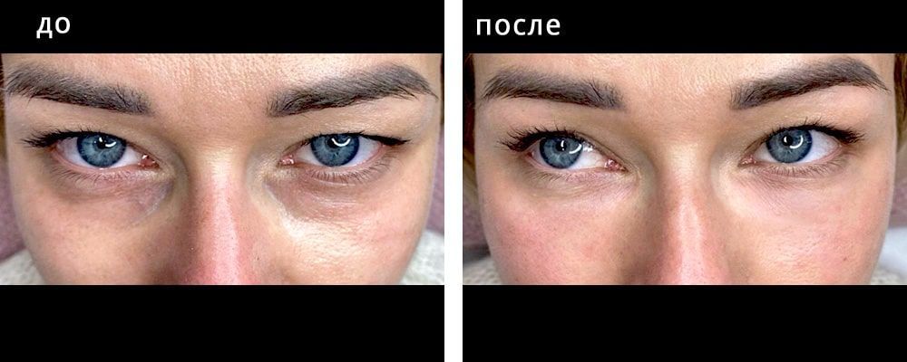 Контурная пластика области глаз. Мельниченко 11: до и после – фото 1