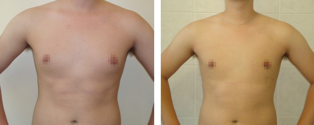 Гинекомастия: до и после – фото 11