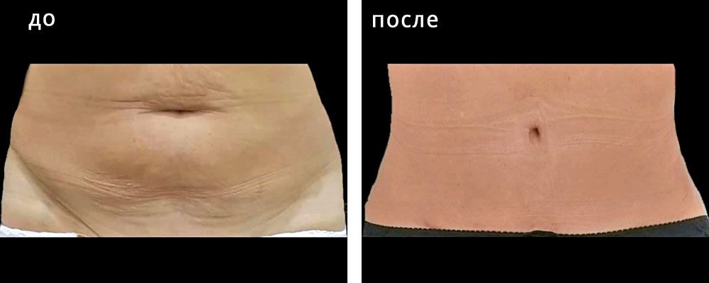 Абдоминопластика: до и после – фото 7