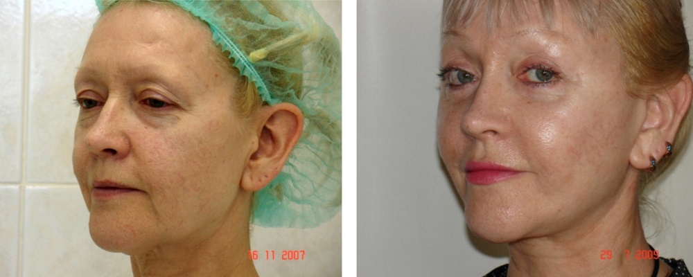 Лифтинг лица: до и после – фото 2