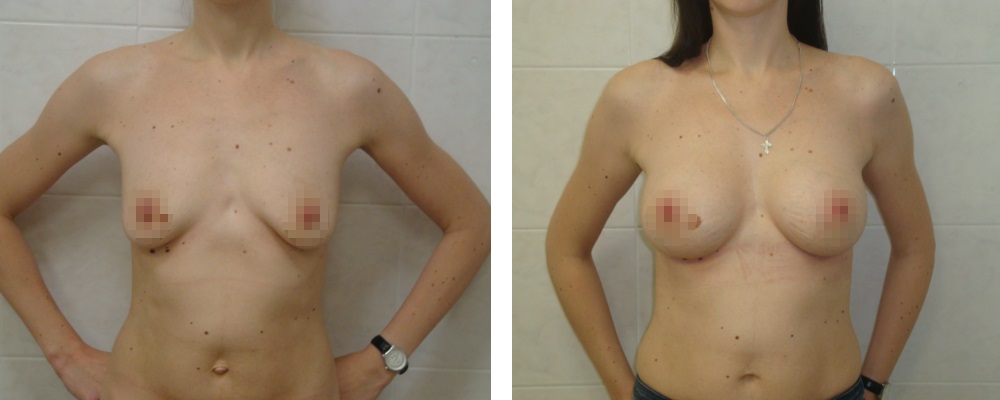 Маммопластика. Еременко В.С._16: до и после – фото 44