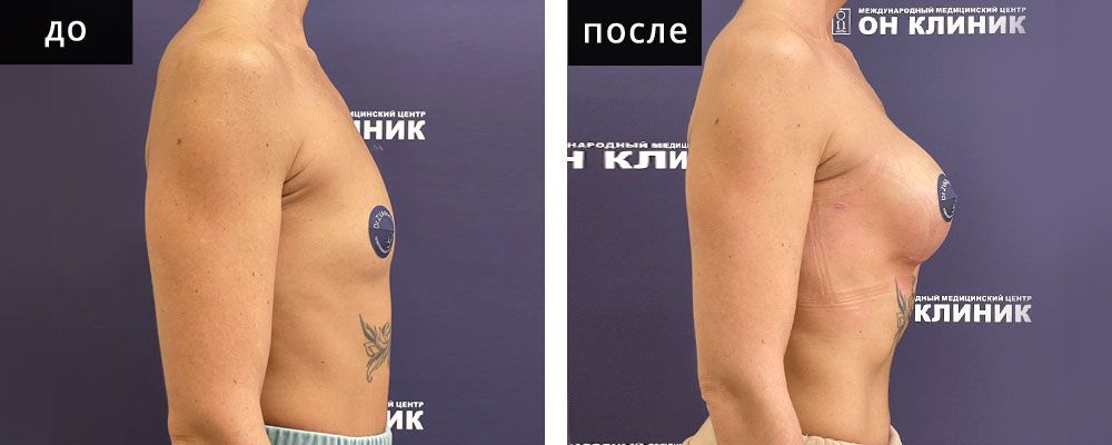 Маммопластика аугментационная. Зварич 09: до и после – фото 34