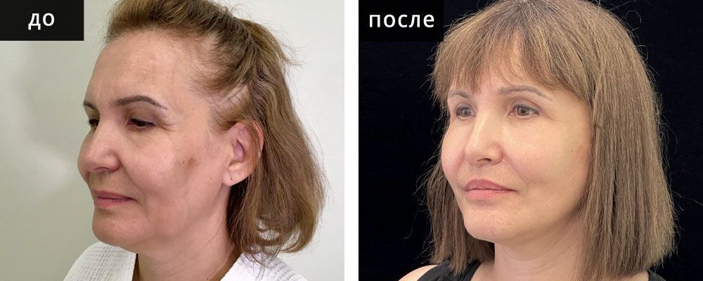 Лифтинг лица: до и после – фото 6