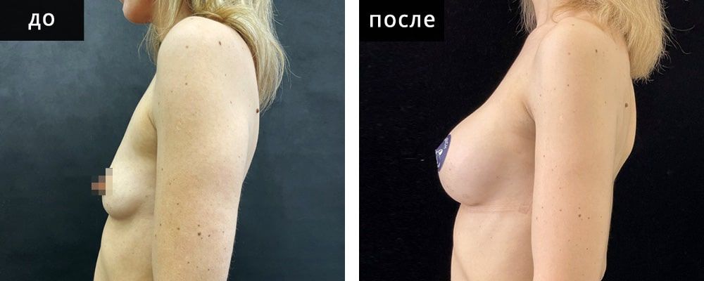 Маммопластика аугментационная. Зварич 05: до и после – фото 30