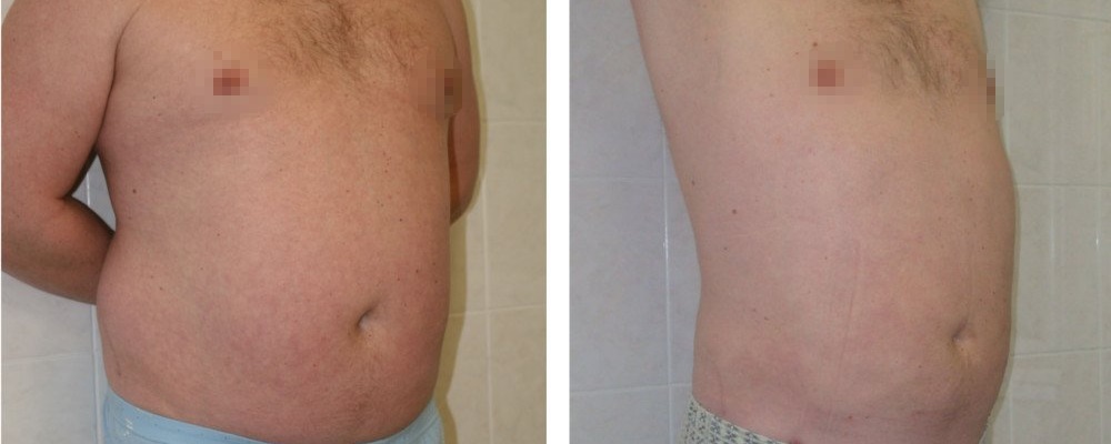 Липосакция для мужчин: до и после – фото 9
