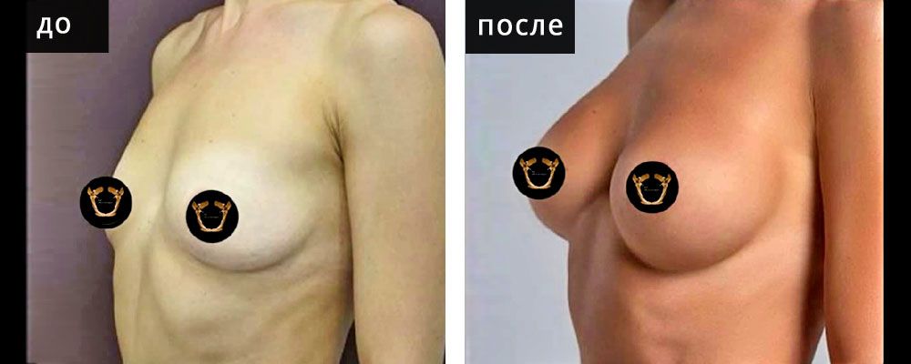 Маммопластика аугментационная. Гусляков 03: до и после – фото 13