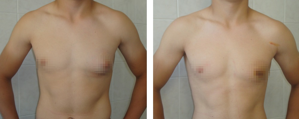 Гинекомастия: до и после – фото 7