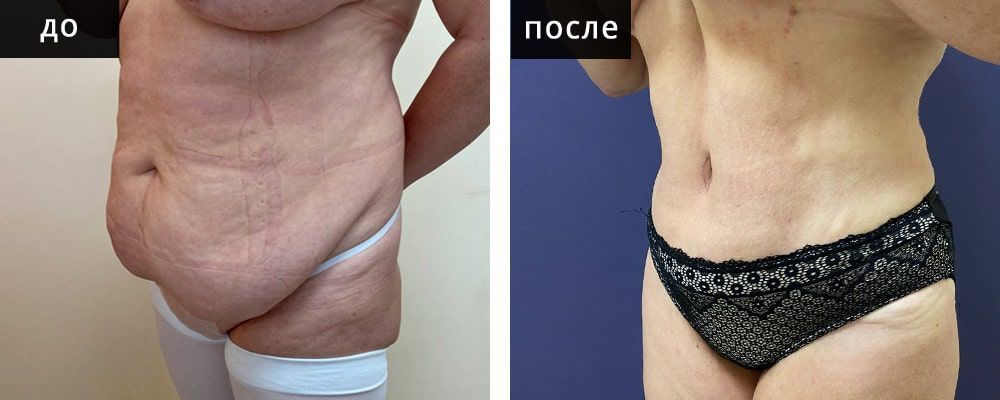 Абдоминопластика: до и после – фото 2