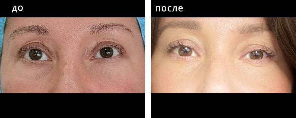 Блефаропластика азиатских глаз. Глебова 08: до и после – фото 5