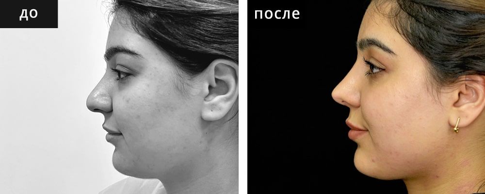Ринопластика. Шах 06: до и после – фото 5