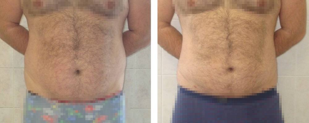 Липосакция для мужчин: до и после – фото 10