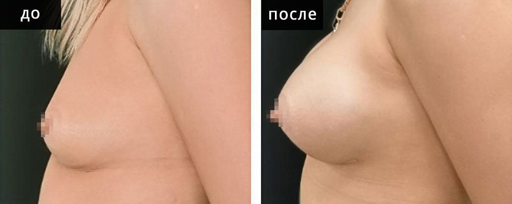 Маммопластика - увеличение груди. Глебова 01: до и после – фото 8