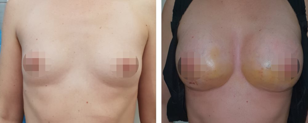 Горячих Мамопластика: до и после – фото 1