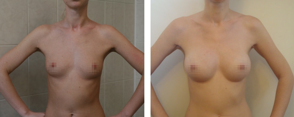 Маммопластика. Еременко В.С._10: до и после – фото 38