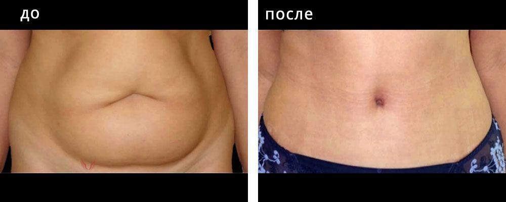 Абдоминопластика: до и после – фото 11