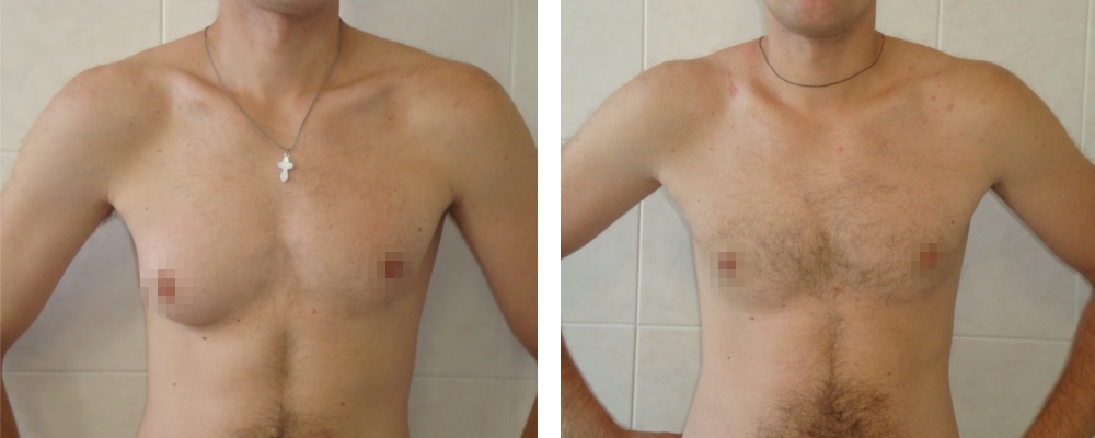 Гинекомастия: до и после – фото 10