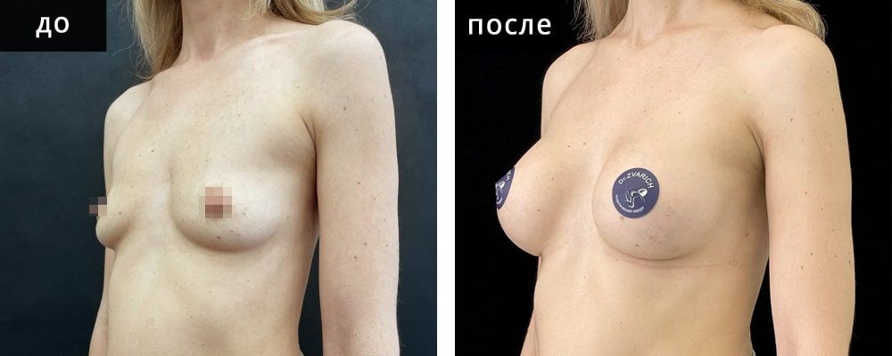 Маммопластика аугментационная. Зварич 04: до и после – фото 29