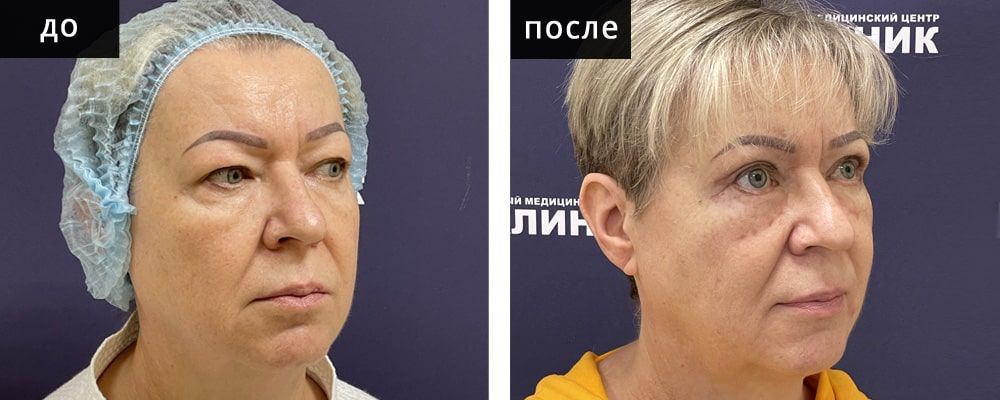 Блефаропластика: до и после – фото 12