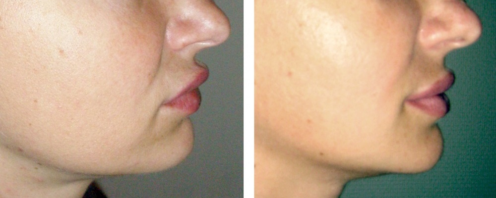 Пластика губ: до и после – фото 1