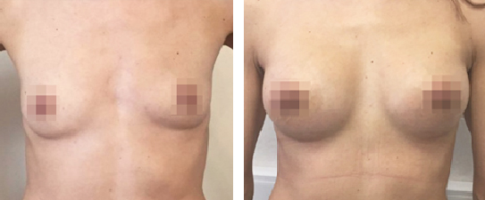 Маммопластика: до и после – фото 23