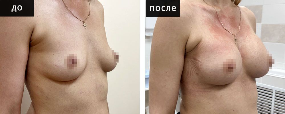 Маммопластика - увеличение груди. Ганьшин 02: до и после – фото 7