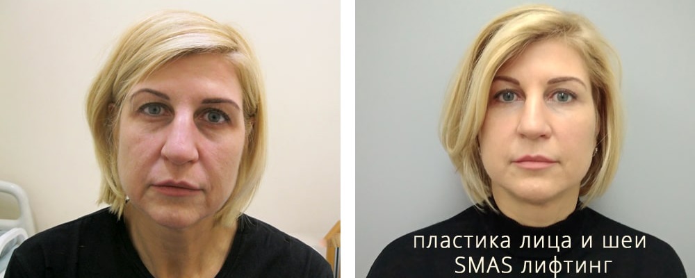 Подтяжка лица. Слоним А.А._04: до и после – фото 1