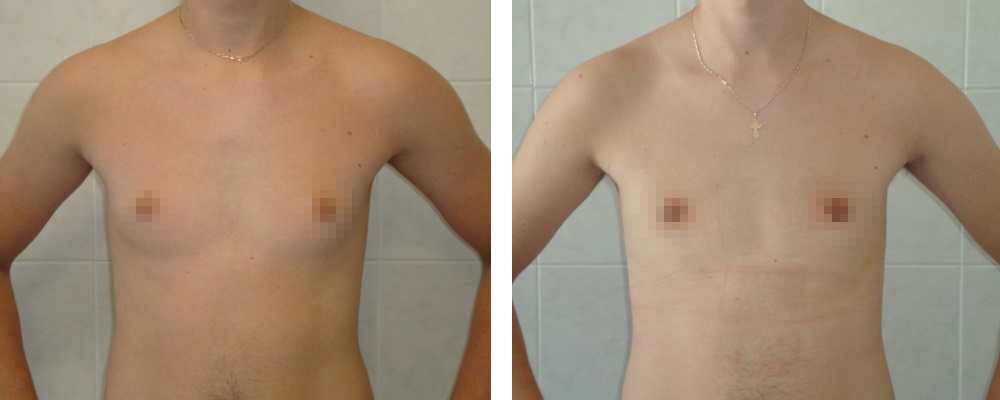 Гинекомастия: до и после – фото 17