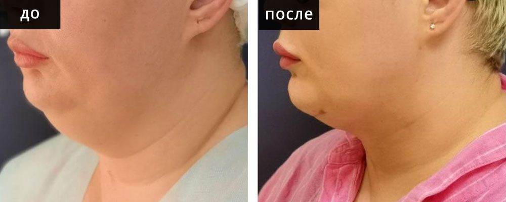 Липосакция шеи. Глебова 02: до и после – фото 4