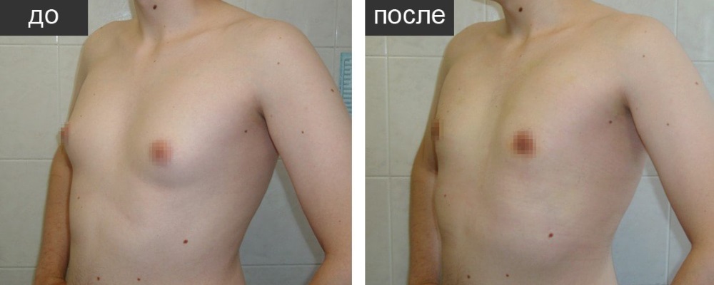 Гинекомастия: до и после – фото 4