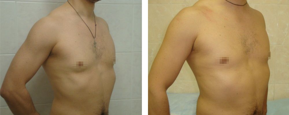 Гинекомастия: до и после – фото 9