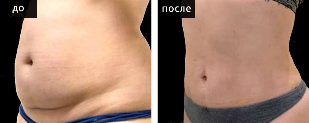 Абдоминопластика: до и после – фото 11