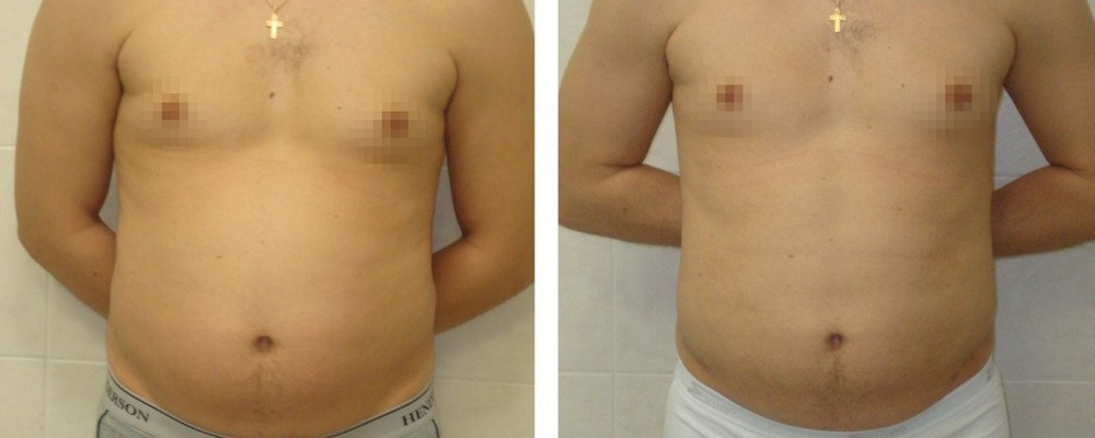 Липосакция для мужчин: до и после – фото 10