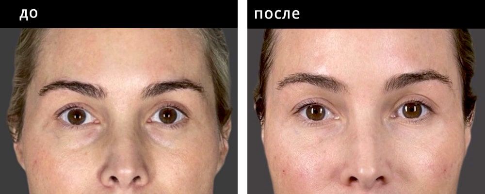 Контурная пластика области глаз. Мельниченко 14: до и после – фото 4