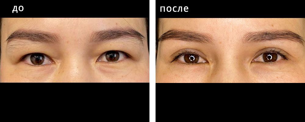 Блефаропластика азиатских глаз. Болотбекова 03: до и после – фото 2