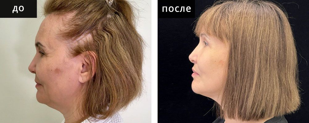 Лифтинг лица: до и после – фото 7